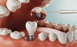 Dr. Zaki’s International Dental Care, Dr. Mohammed Zakiuddin
