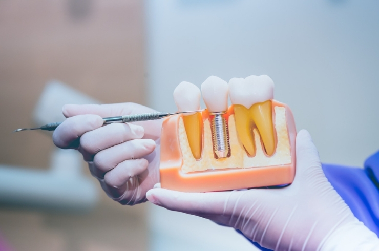 Dental Implantology